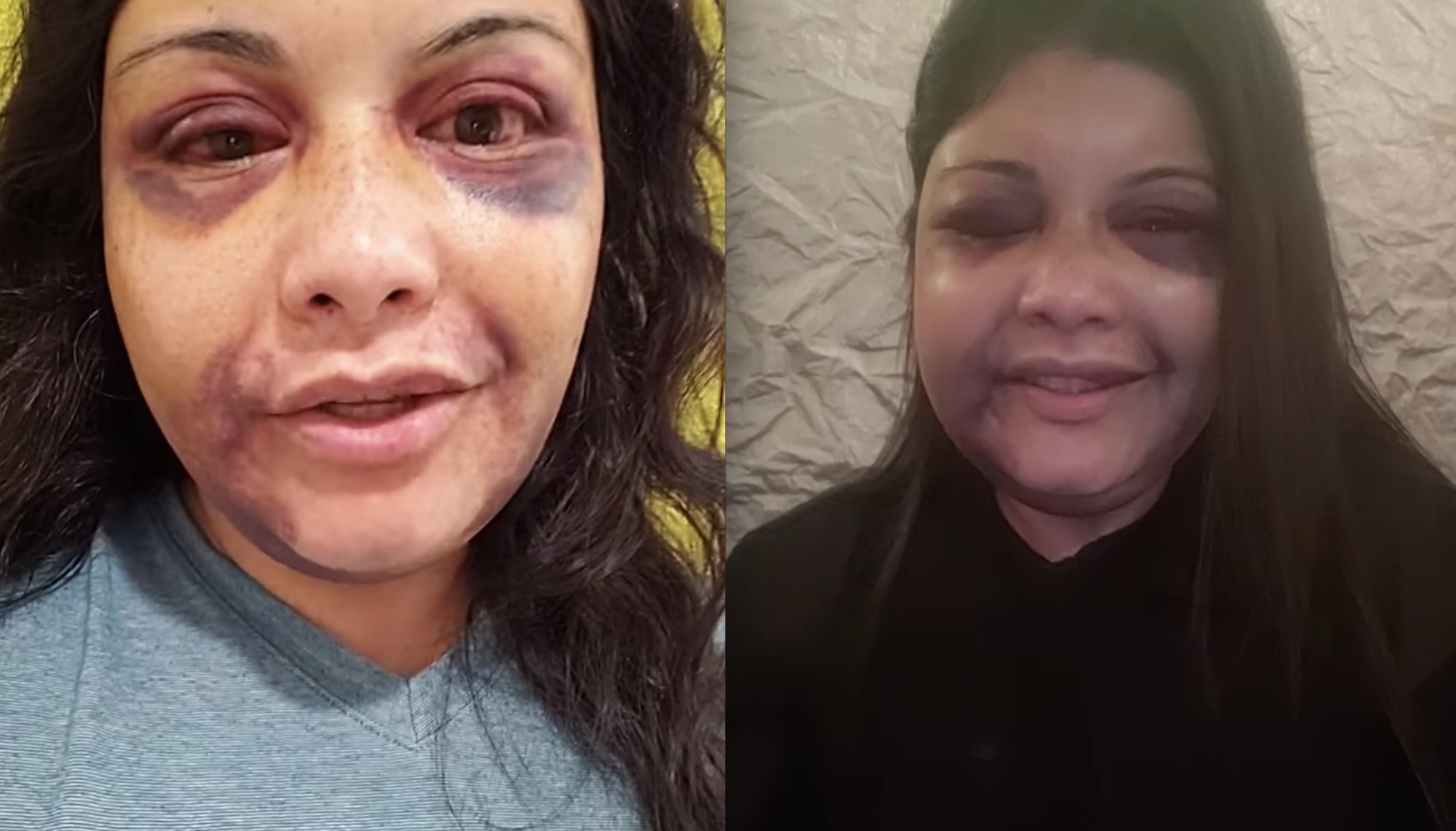 Vanessa Tijerina after hotel attack